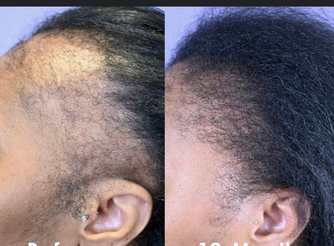 ALOPECIA Booster extra strength rosemary and fenugreek herbal hair growth oil