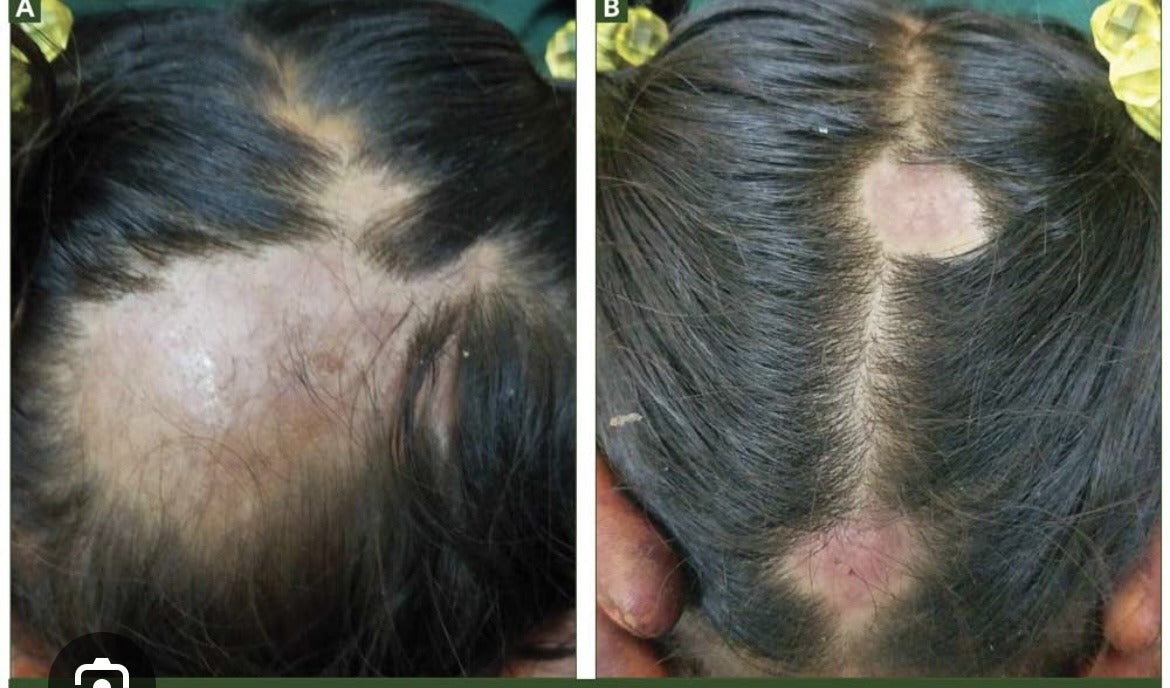 ALOPECIA BOOSTER EXTRA STRENGTH SET/ INDIAN POMADE HAIR GROWTH.