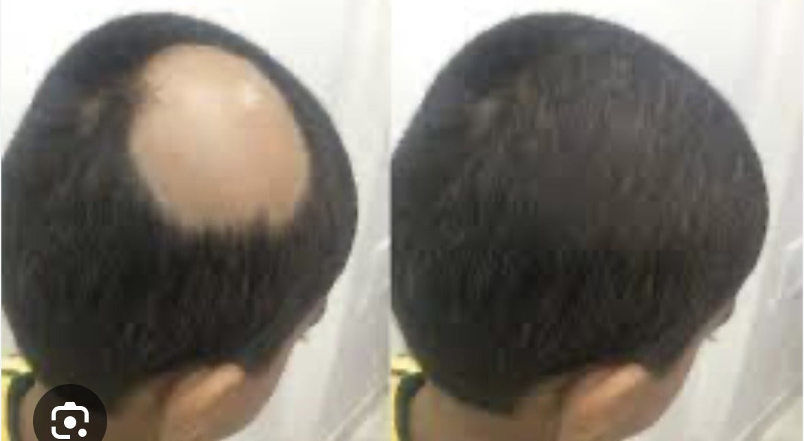 ALOPECIA BOOSTER EXTRA STRENGTH SET/ INDIAN POMADE HAIR GROWTH.