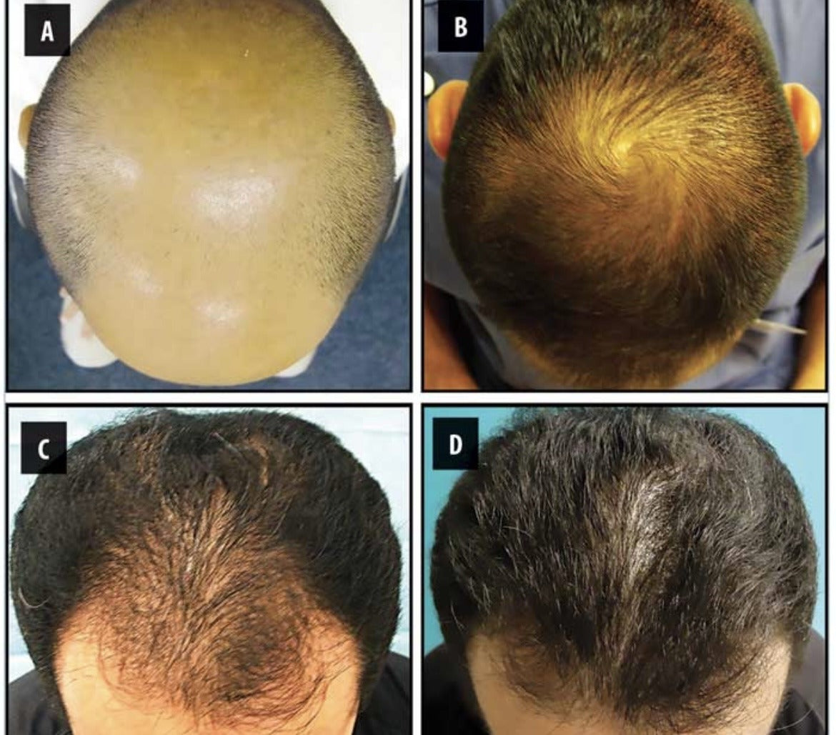 ALOPECIA BOOSTER EXTRA STRENGTH SET/ INDIAN POMADE HAIR GROWTH.